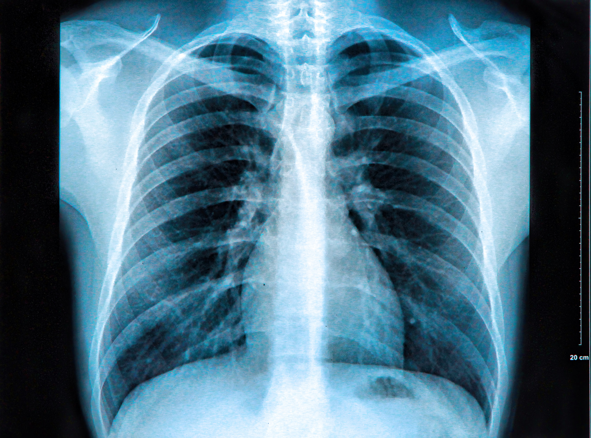 X-Ray image of the human chest